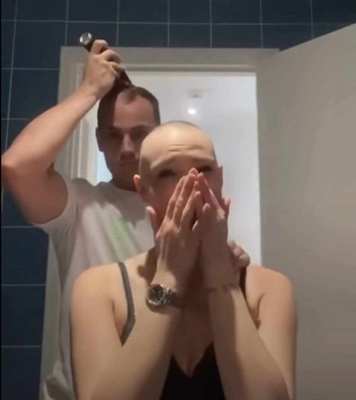 Man goes bald after shaving girlfriend's head who suffers from Alopecia